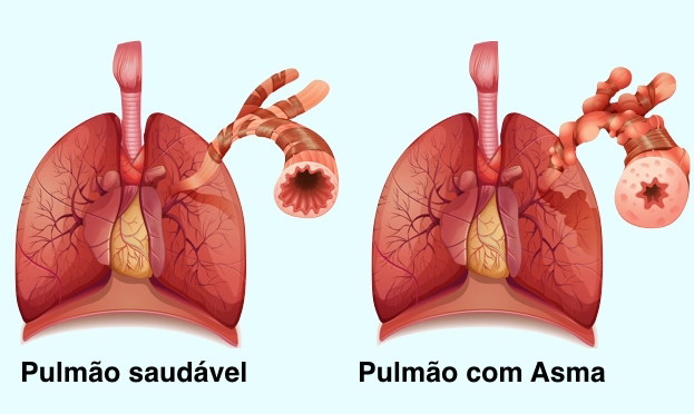 figura que mostra um pulmão saudável à esquerda e um pulmão com asma à direita